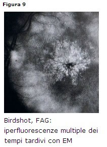 Corioretinopatia tipo birdshot
