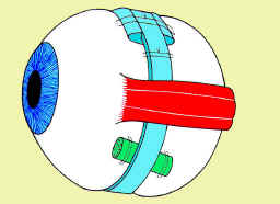 Schema di chirurgia ab-externo