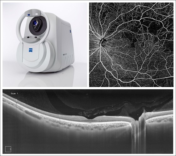 Portale di Oculistica - Modelli OCT e Angio-OCT