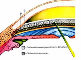 Laser trabeculoplastica