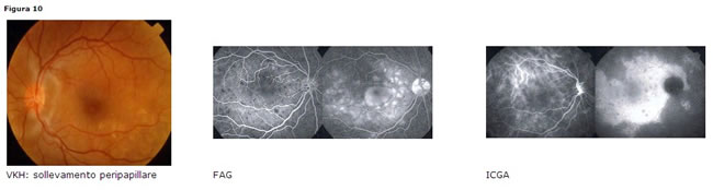 Sarcoidosi retinica