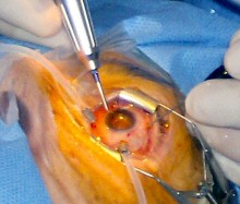 Campo chirurgia ab-interno/vitrectomia