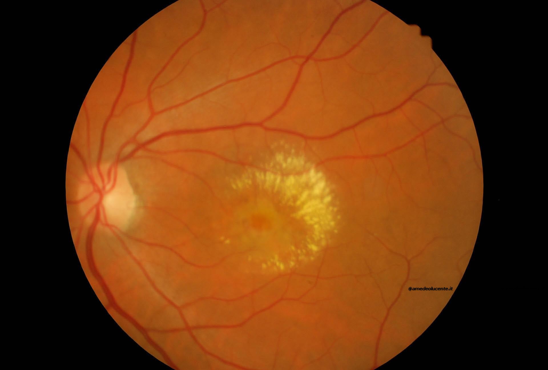 Maculopatia edematosa evoluta per cisti pseudovitellina