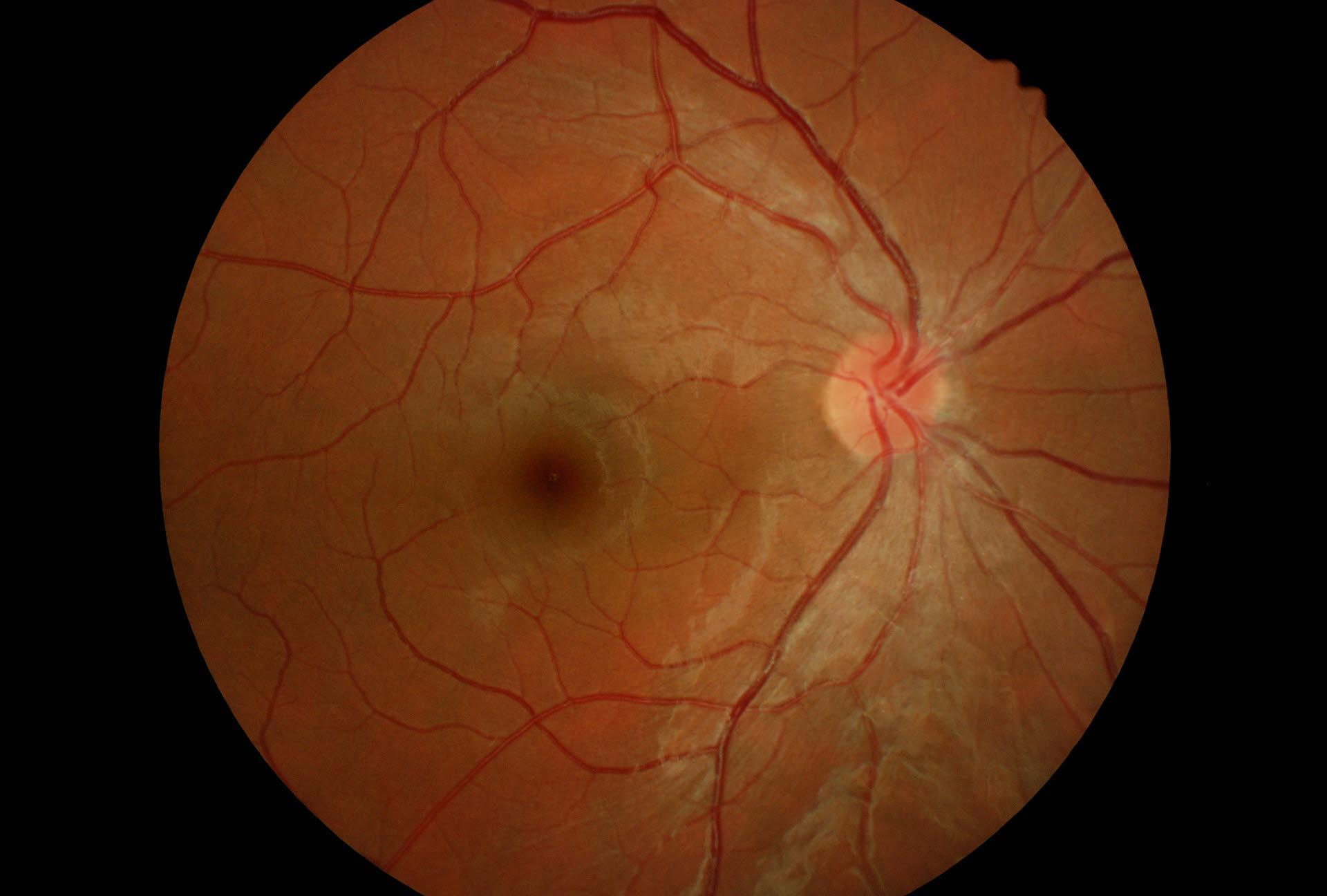 Cisti pseudovitellina monolaterale