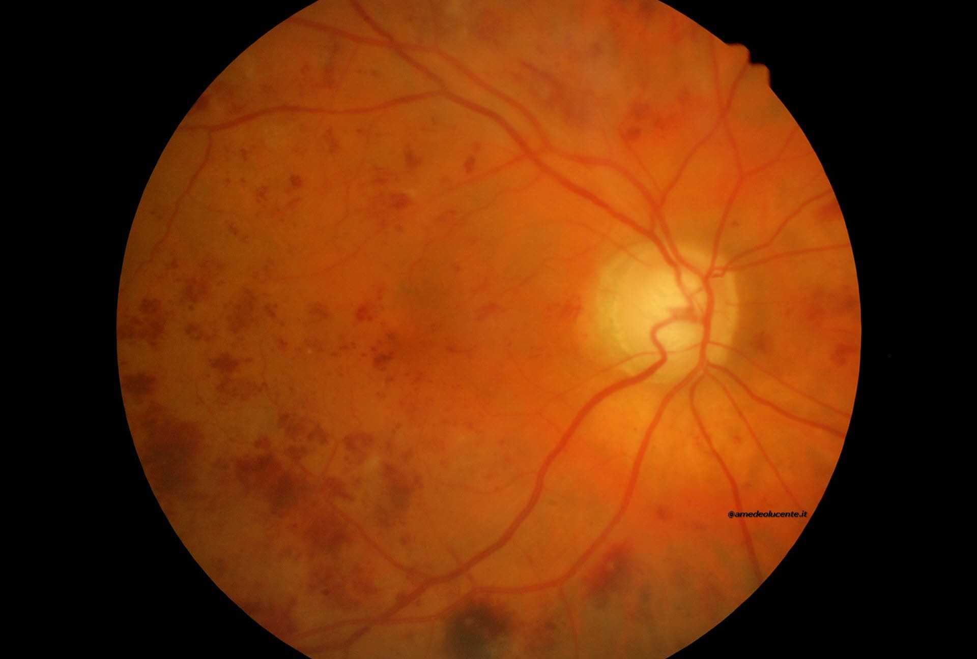 Retinopatia Emorragica da leucemia cronica