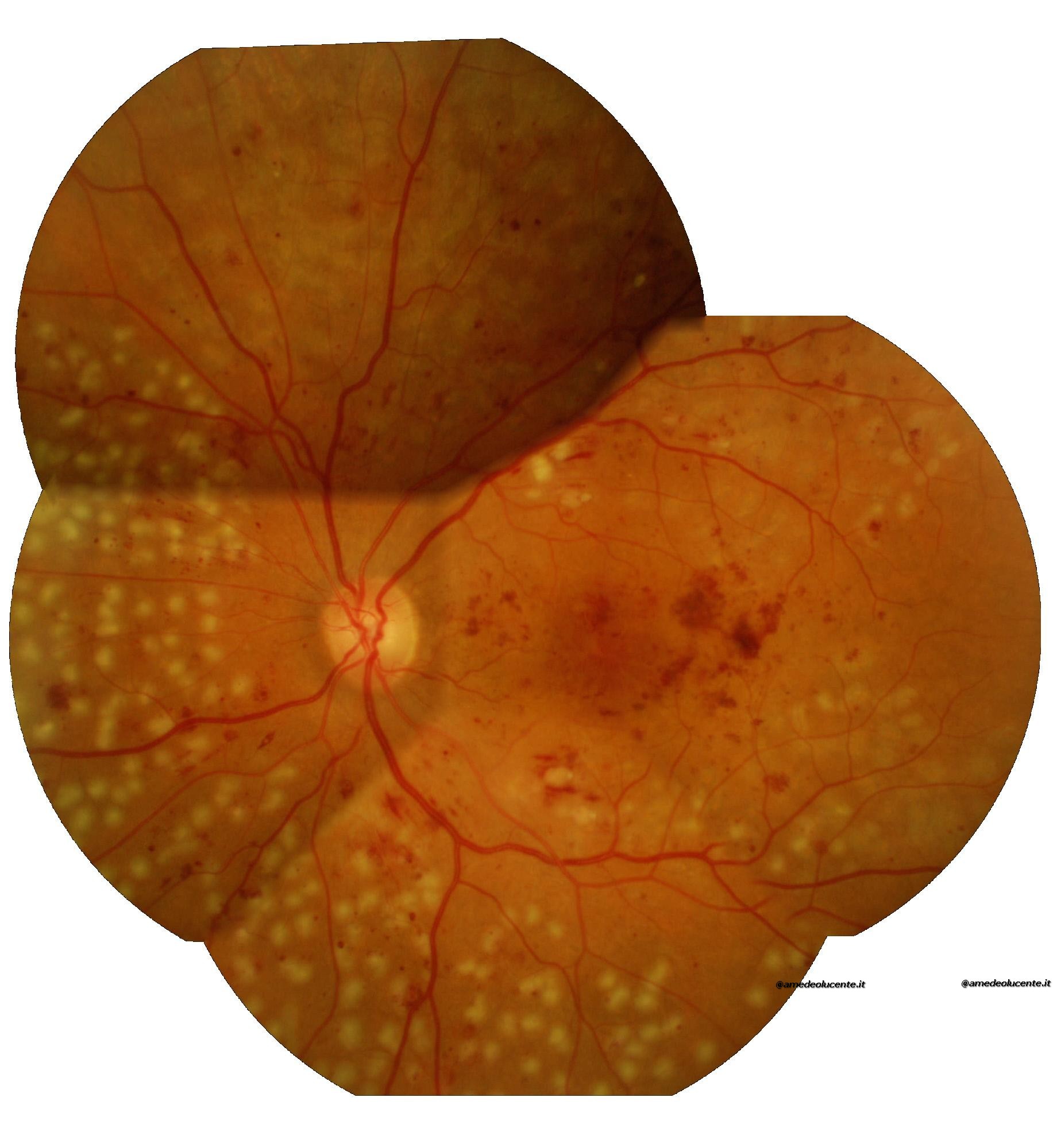 Retinopatia Diabetica pre-proliferante in trattamento argon panretinico