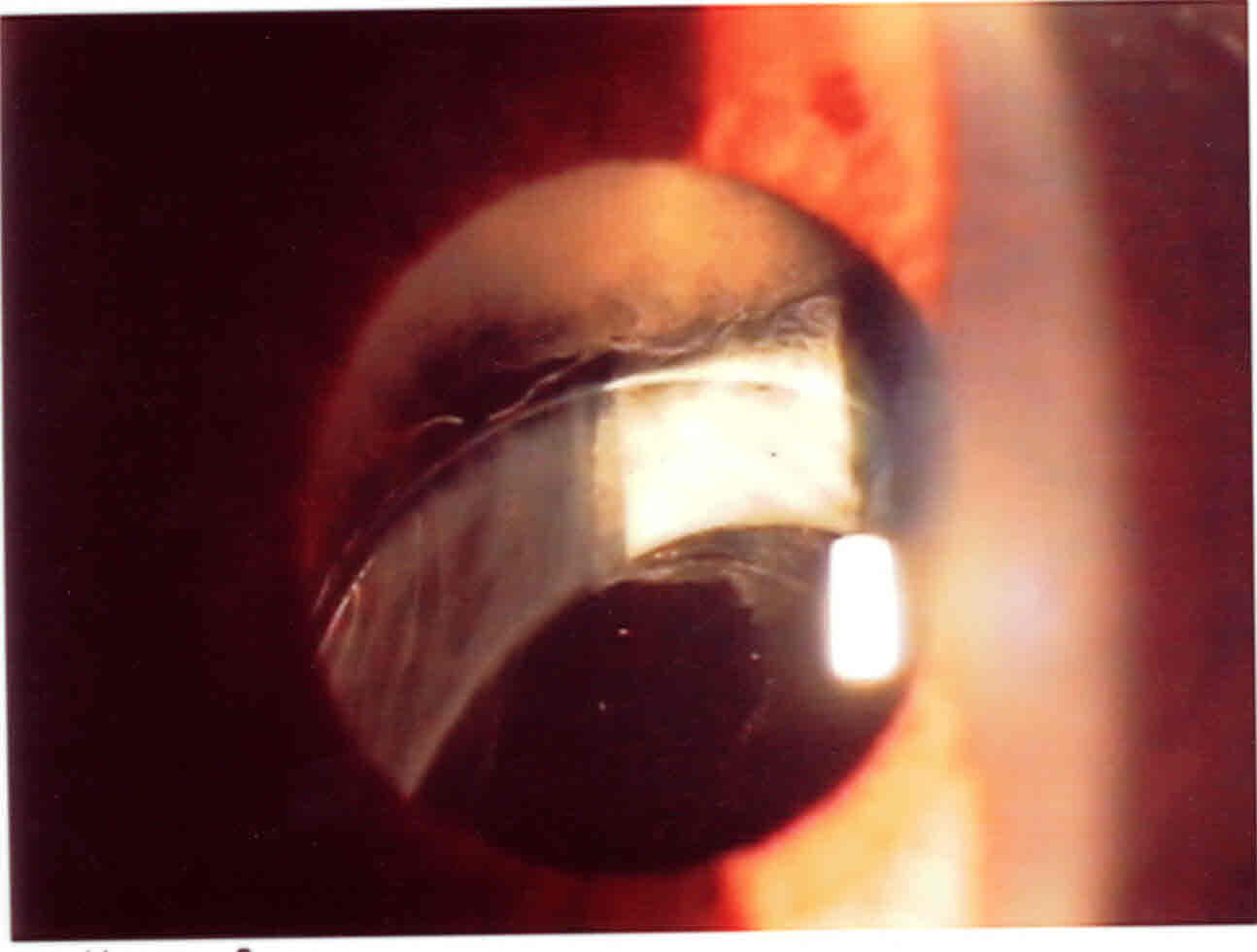 Caduta di IOL in Camera Vitrea