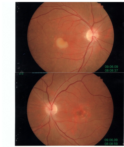 Cisti vitelliforme binoculare