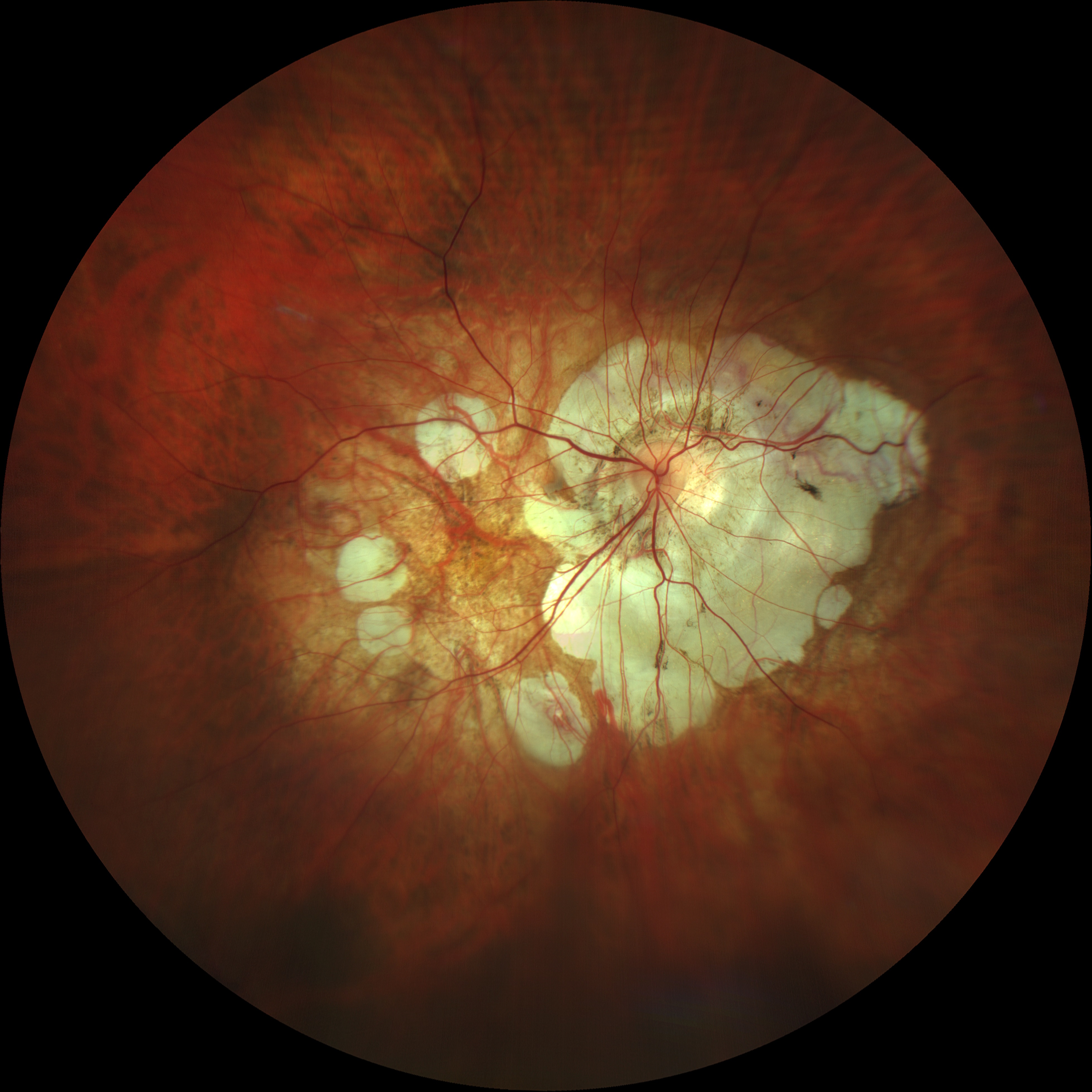 Imaging Wide Field miopia elevata