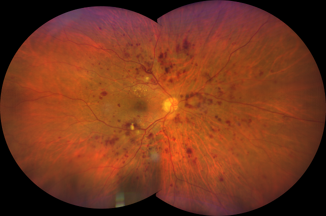 Immagine a 200 gradi di retinopatia diabetica con Clarus 500 Zeiss Wide Field Device
