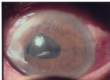 Edema corneale con IOL in Camera Anteriore