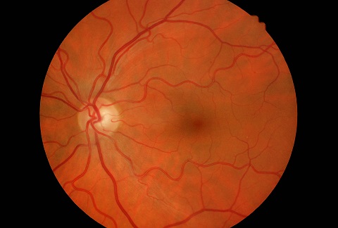 Deficit fascicolare
