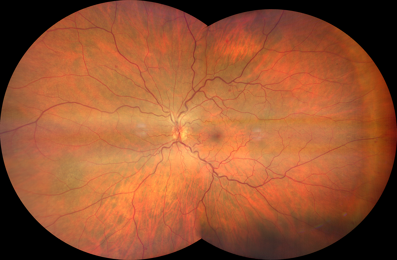 Sub Occlusione vena centrale della retina dopo Astrazenica