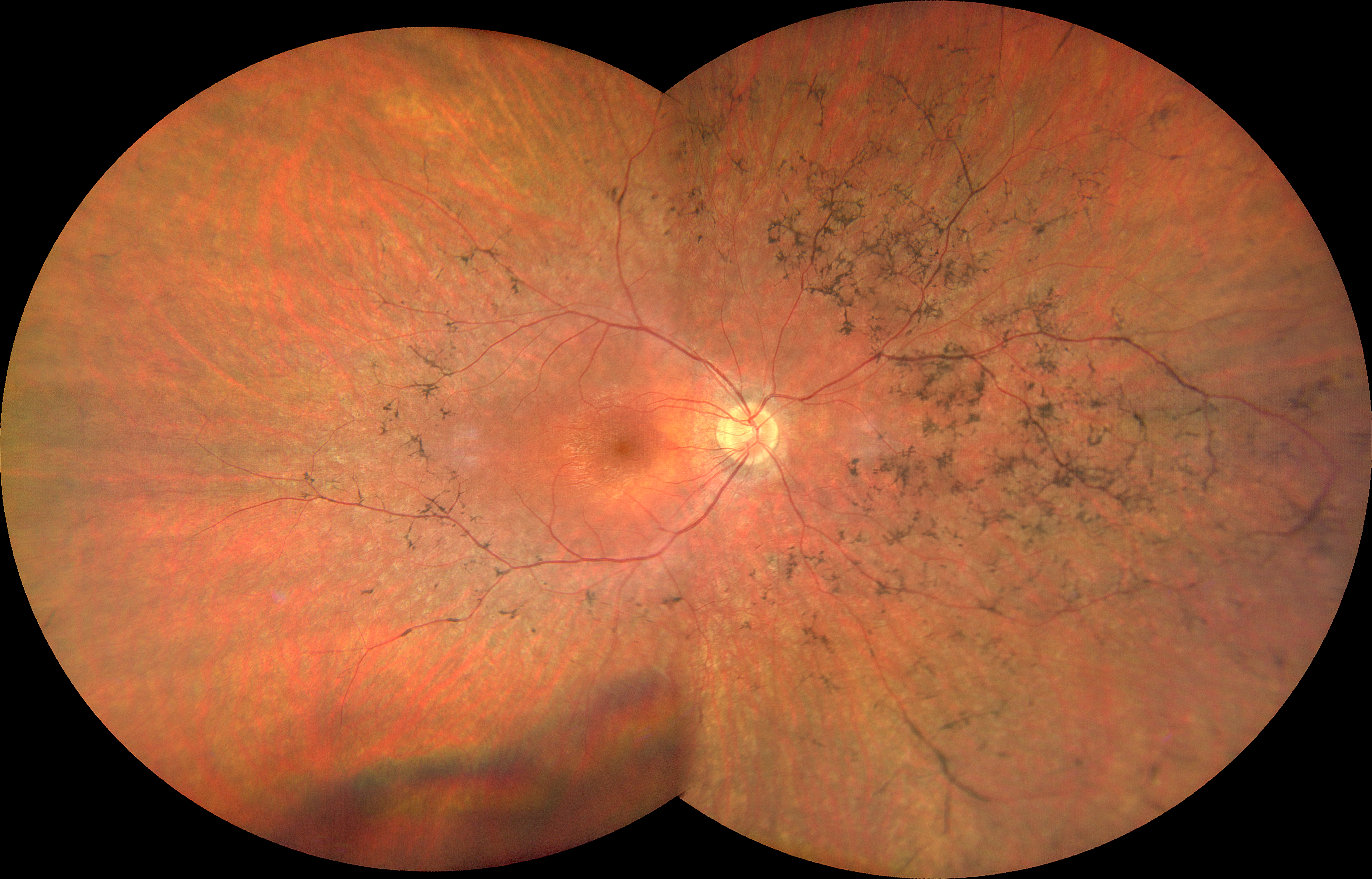 Retinopatia pigmentosa