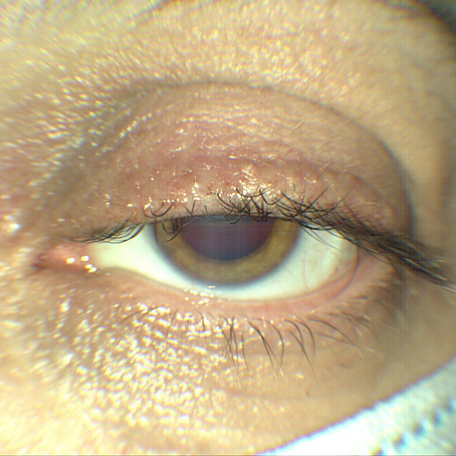 Ptosi palpebrale