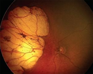 by American Accademy of ophthalmoloy: Researchers in Brazil are reporting vision-threatening retinal lesions in babies born with microcephaly that appear to be linked to infection with the mosquito-borne Zika virus