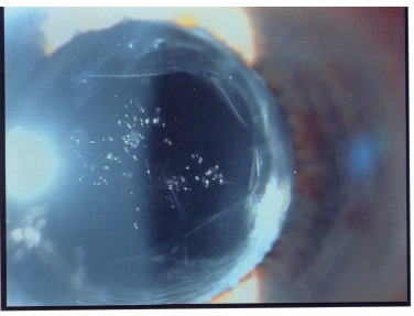 Pitting della IOL da Yag Laser