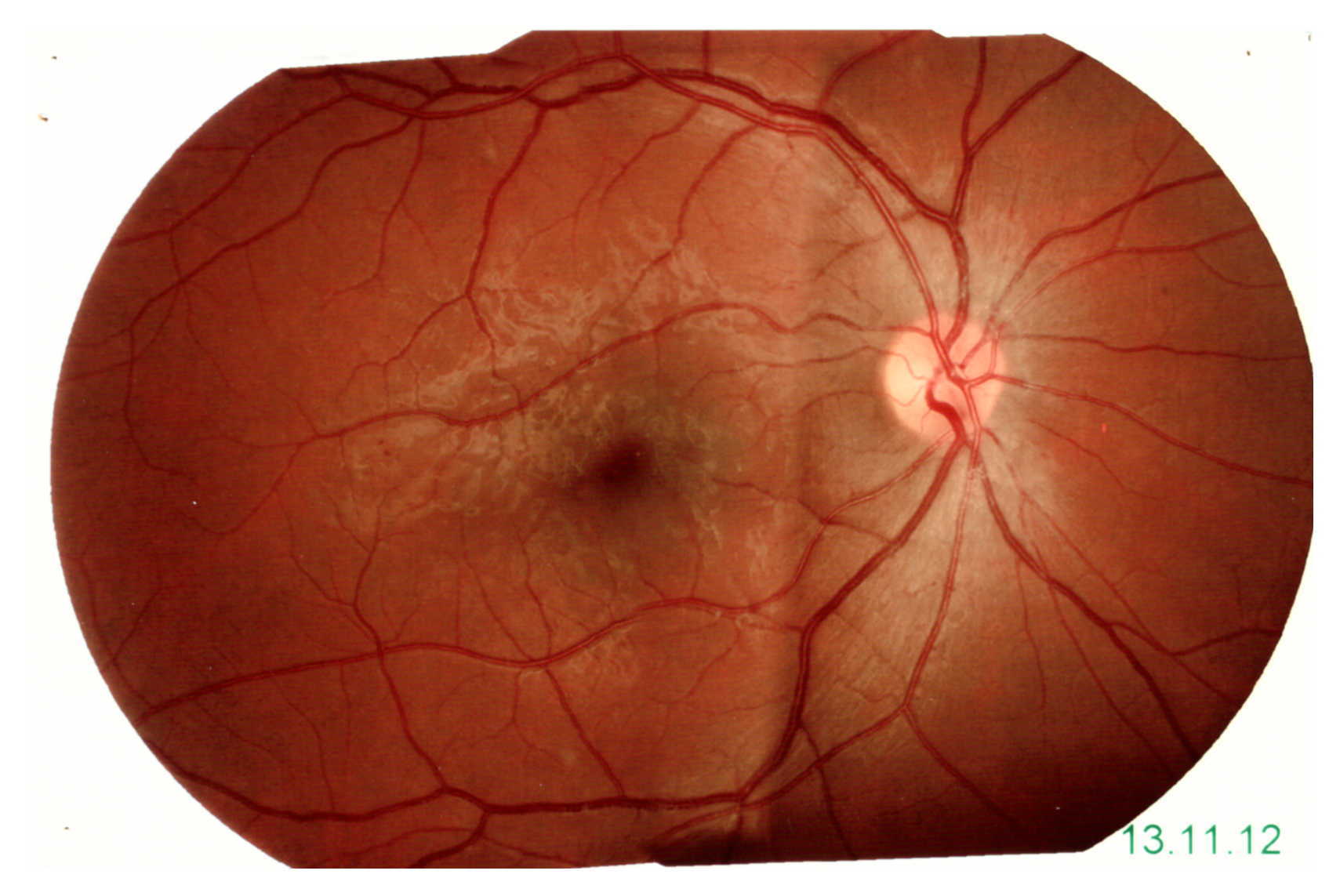 Retinopatia diabetica in giovane trentenne insulinodipendente