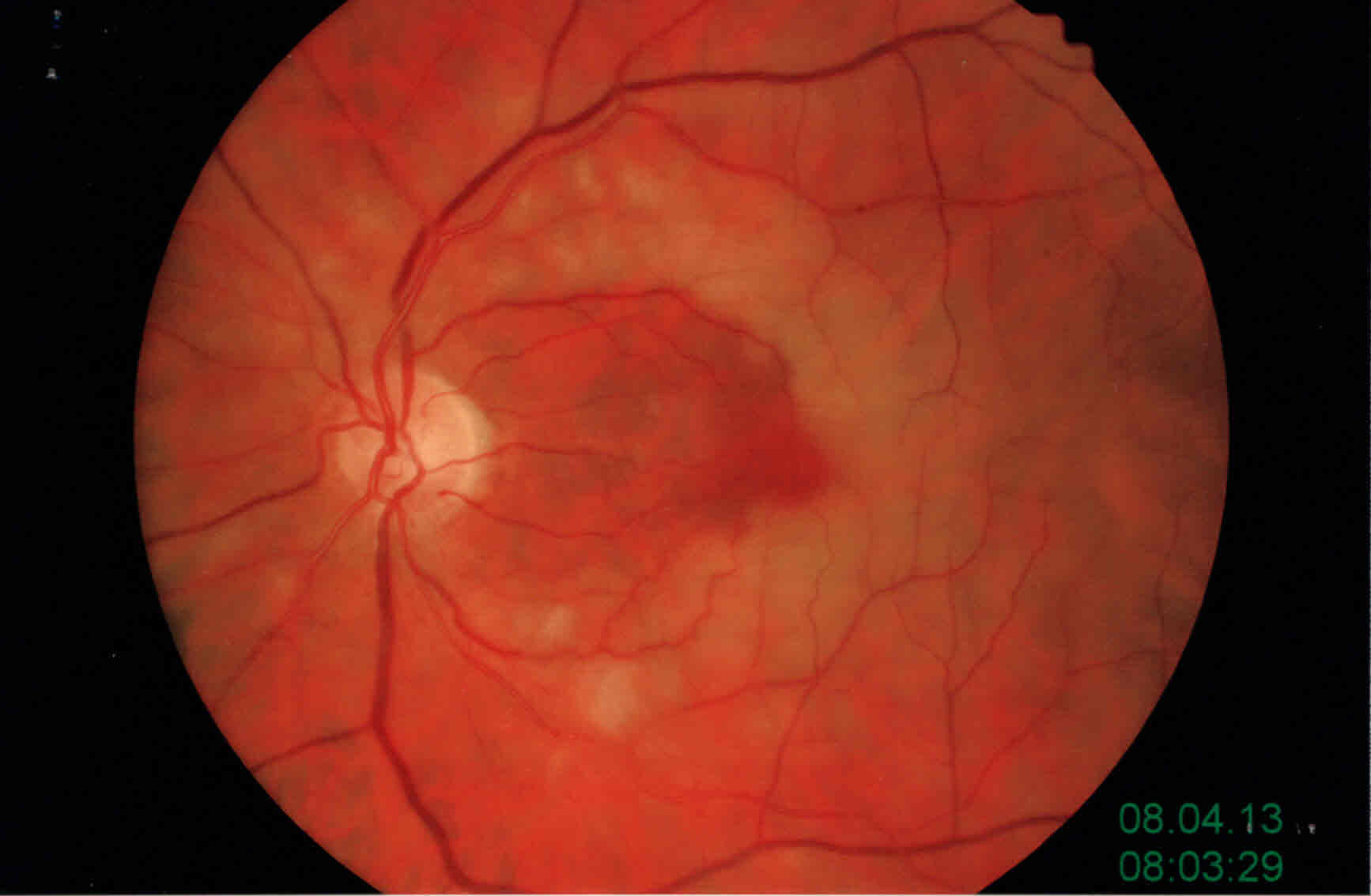Occlusione parziale Arteria Centrale Retina