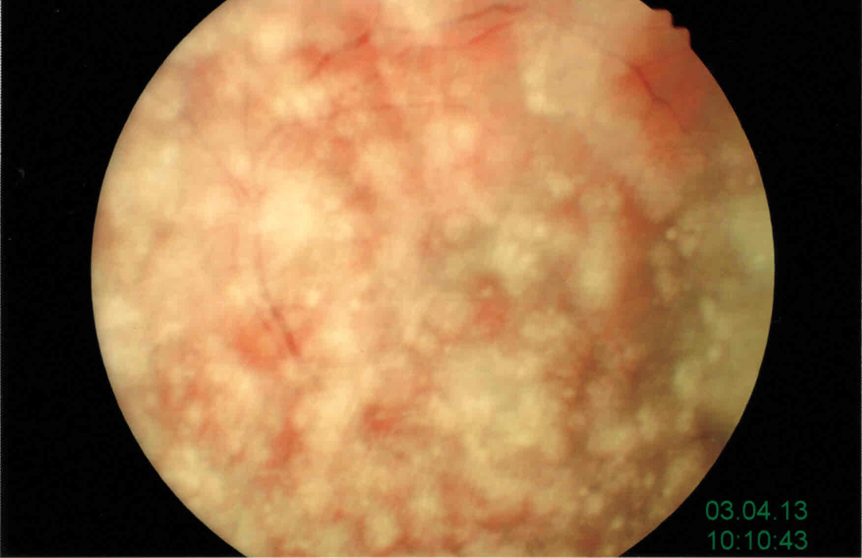 Vitreopatia Asteroide