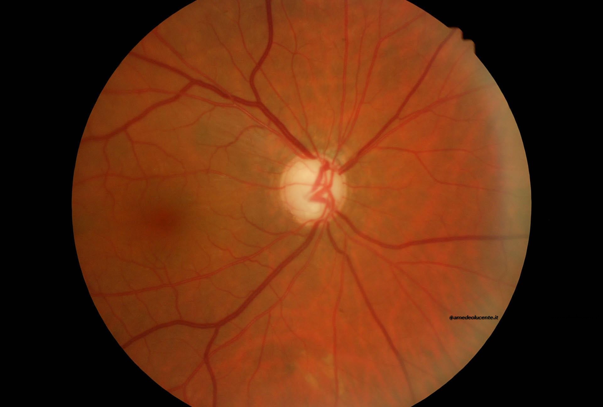 Glaucoma assoluto non rispondente a terapia medica