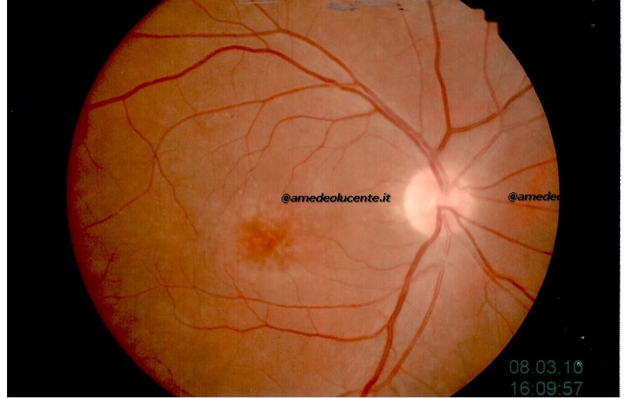 Maculopatia vitelliforme in evoluzione