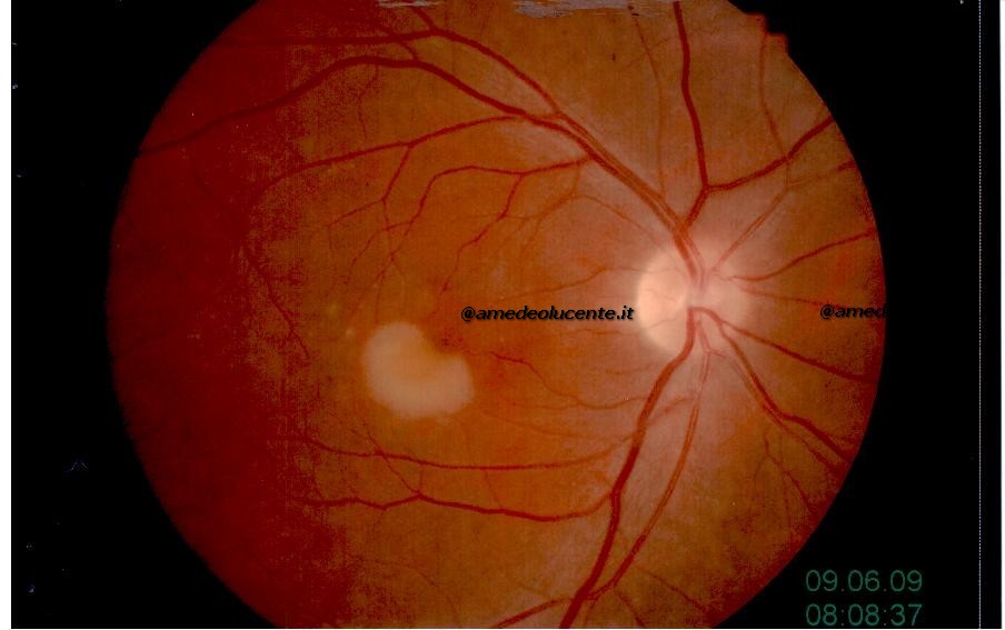 Maculopatia vitelliforme in evoluzione