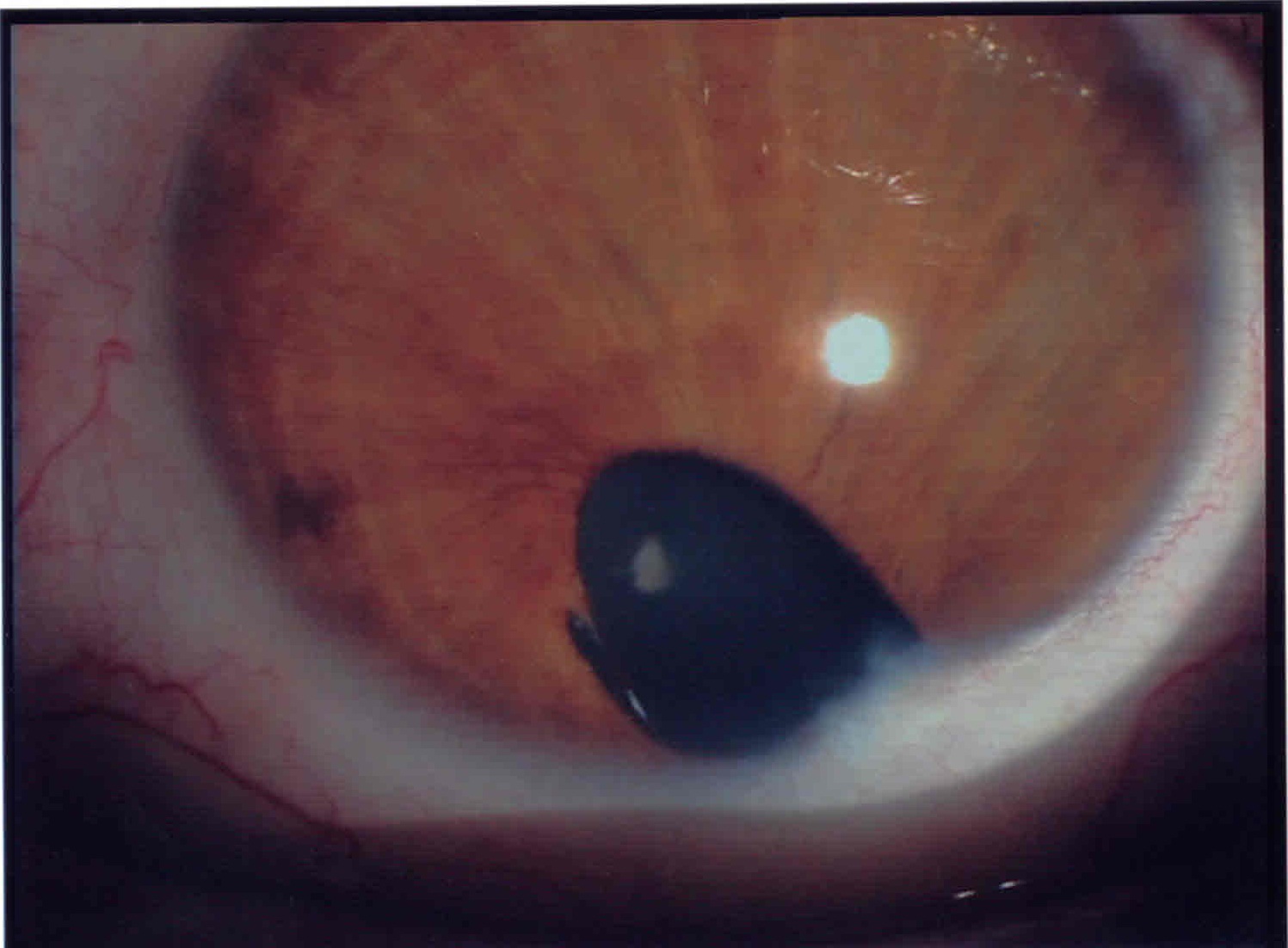 Pseudocoloboma