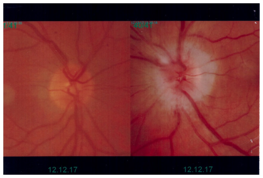 Otticopatia Ischemia anteriore