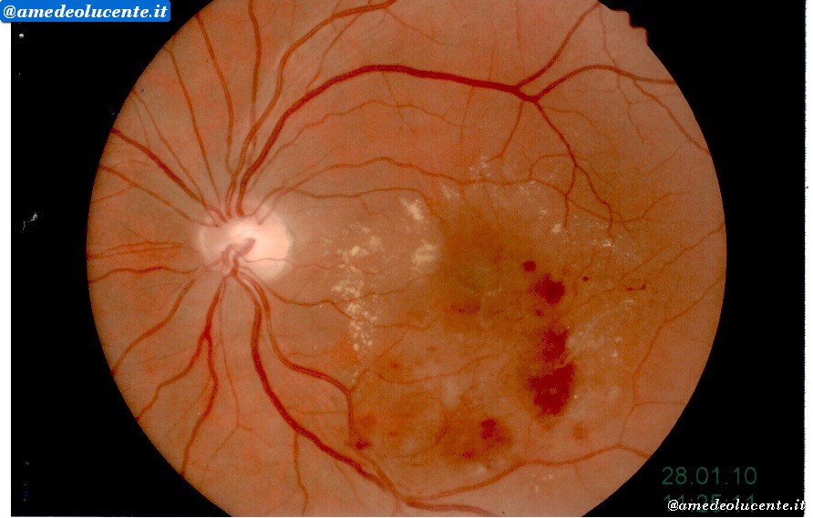 Occlusione di branca migliorata dopo 4 anni