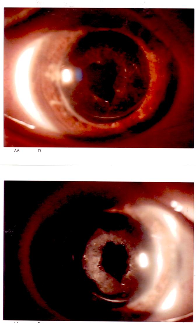 Capsulotomia Yag laser con riproliferazione