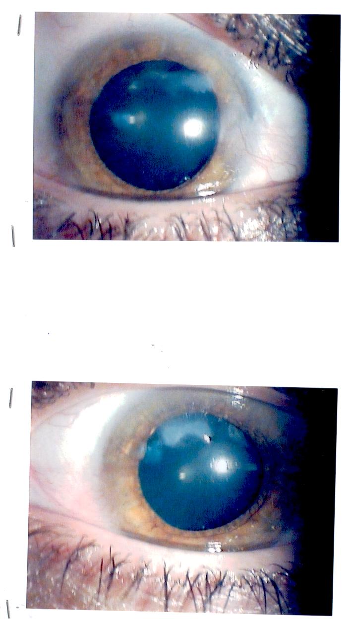 Degenerazione marginale corneale bilaterale