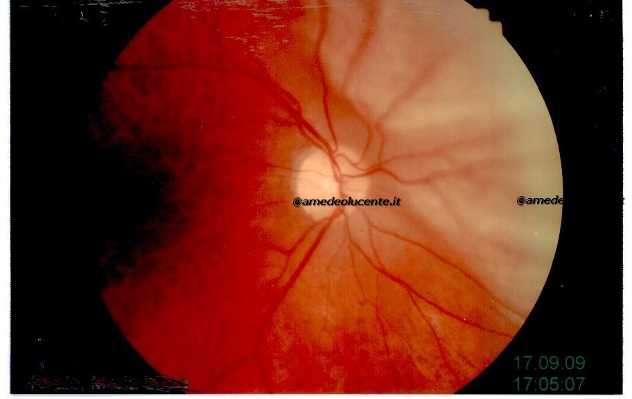 distacco di retina nasale pre e post-operatorio