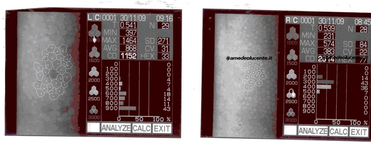 Conta endoteliale dopo 10 anni di silicone in camera anteriore