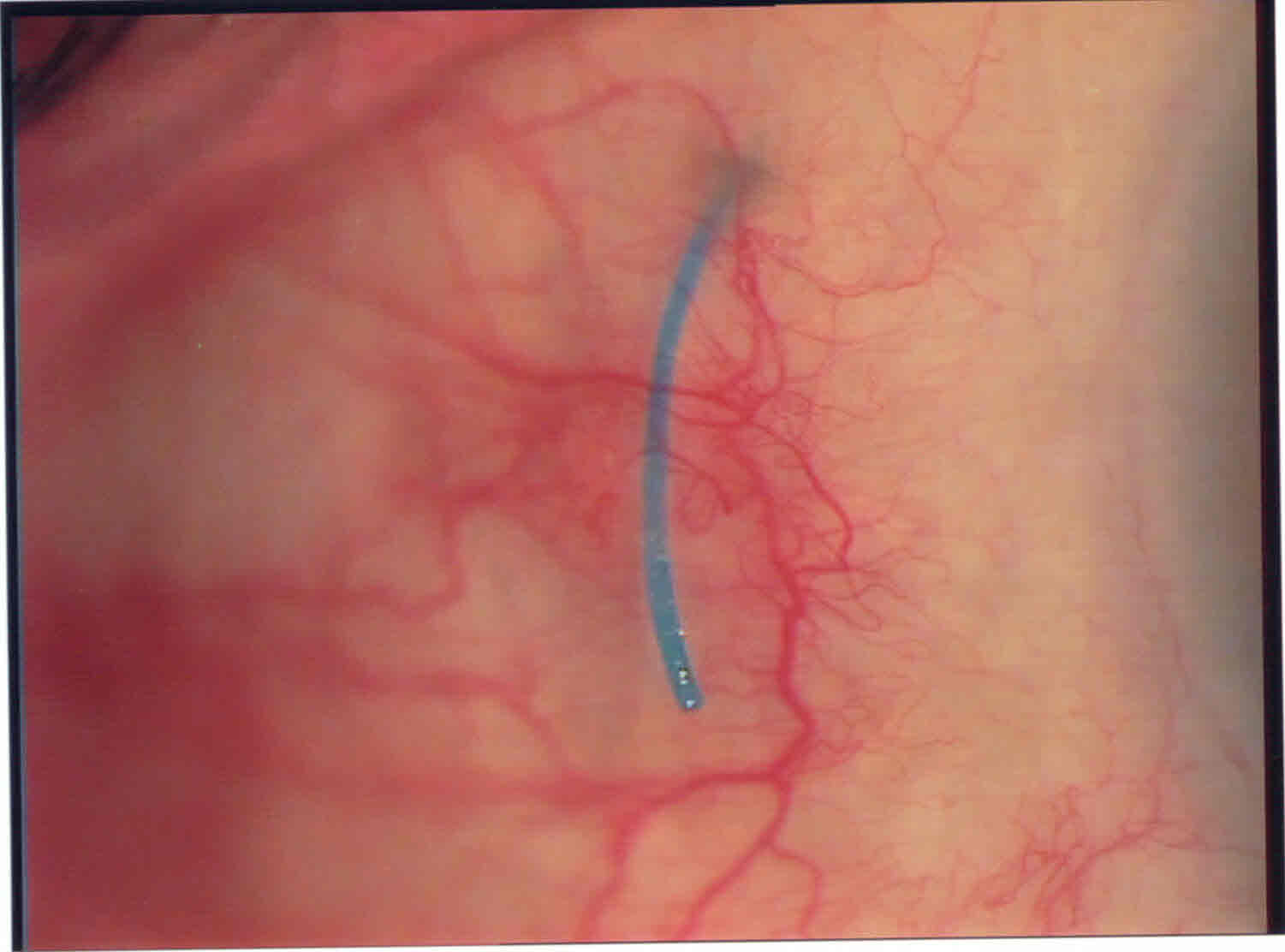 Loop di IOL sulla sclera