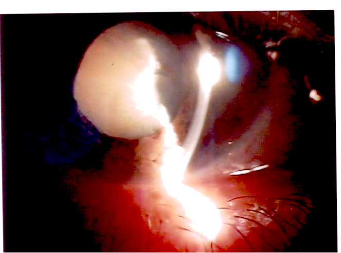 Cataratta traumatica con rottura capsula