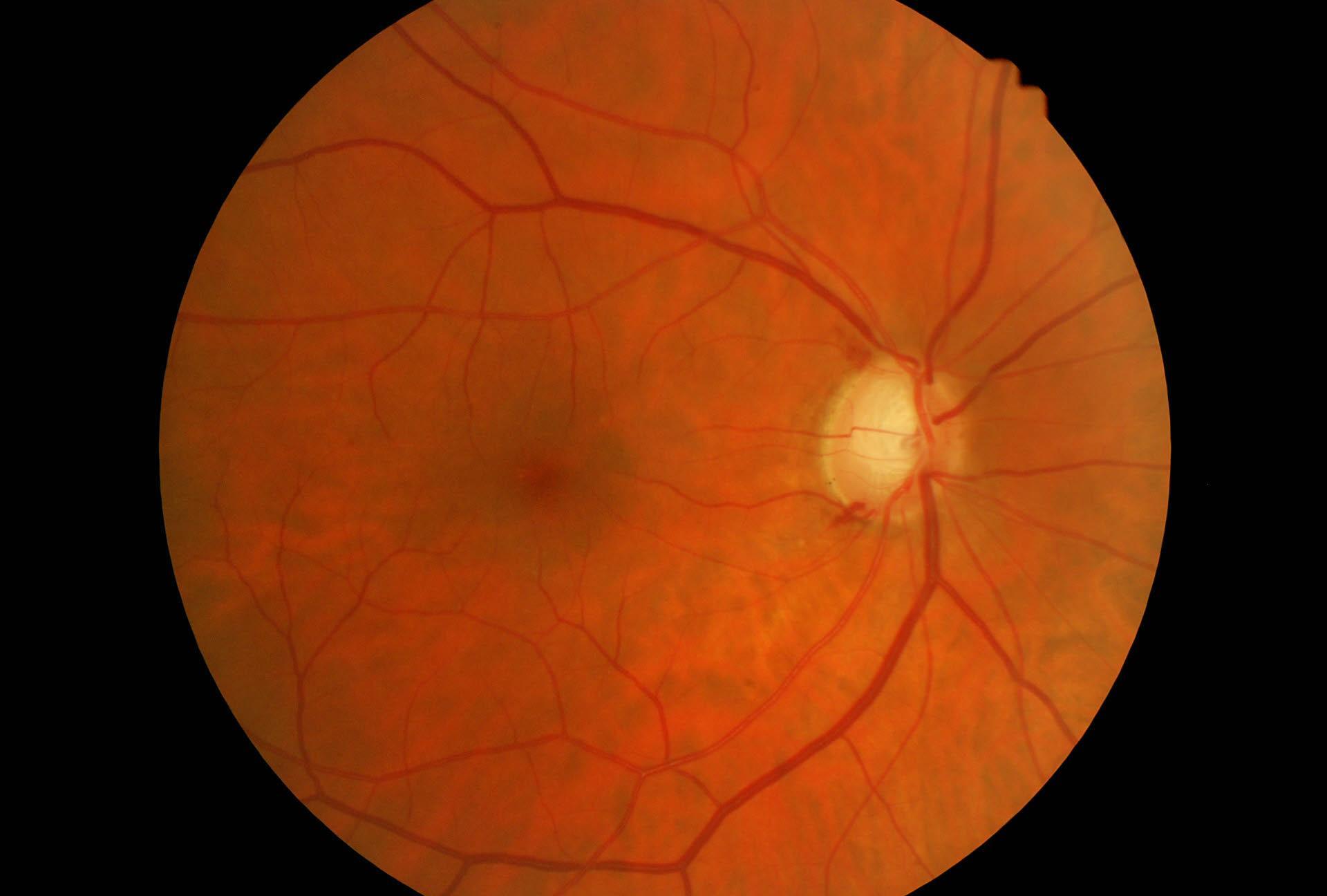 Emorragie papillari in glaucoma
