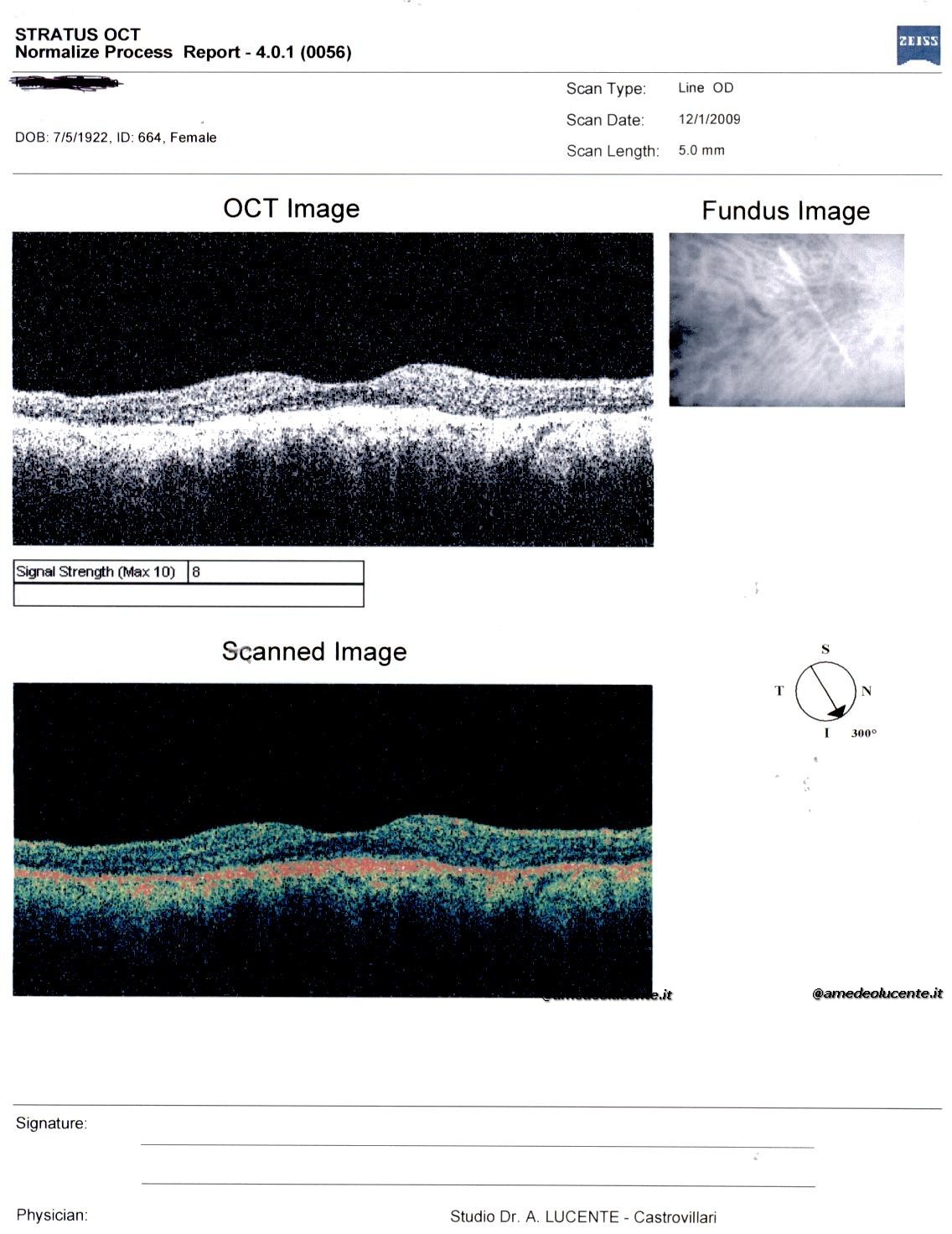 Membrana neovascolare retinica dopo anti-VEGF