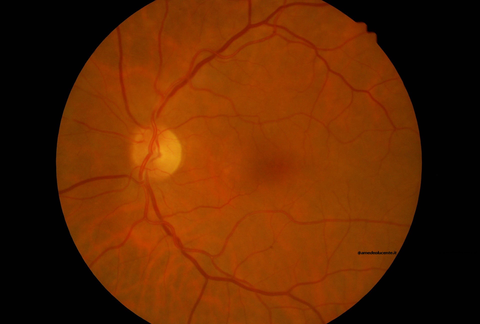Occlusione arteria centrale retina