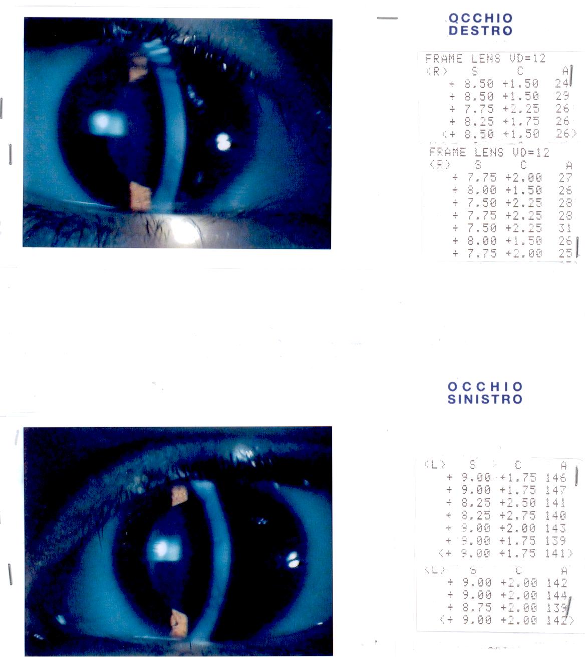 Ipermetropia elevata con cornea plana