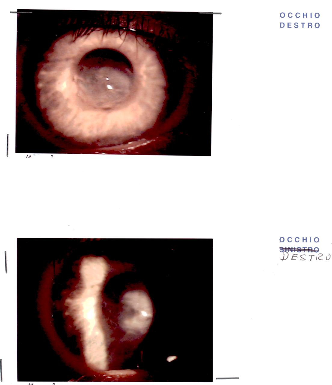 Cheratocono acuto