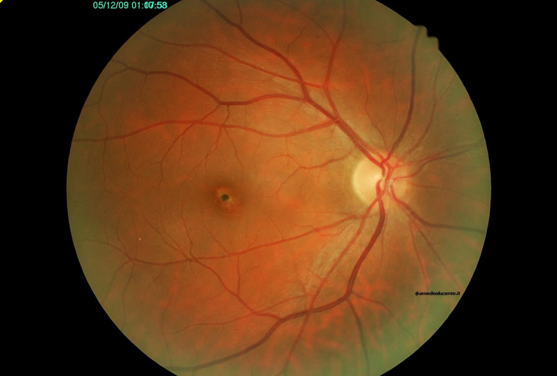 Lesione maculare accidentale da Yag laser