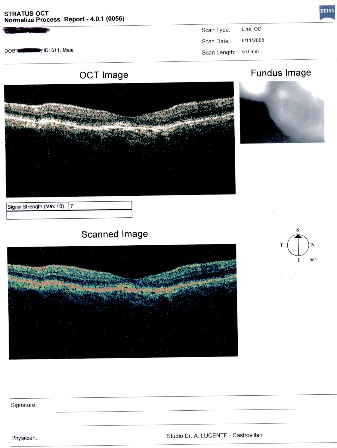 Distacco del neuroepitelio dopo  intervento di cataratta