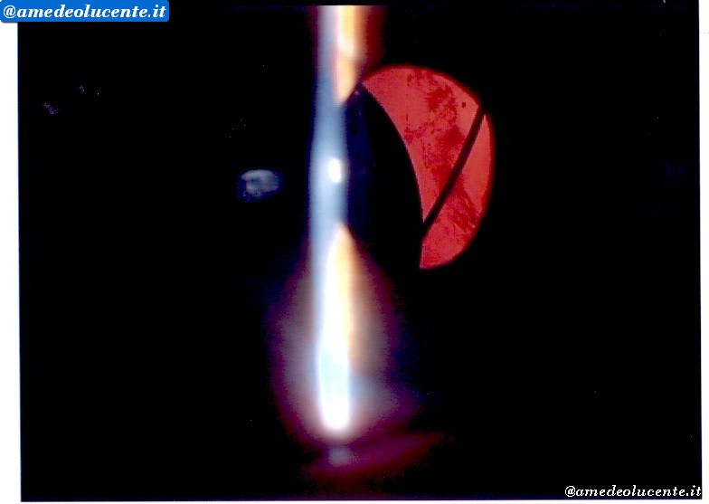Cornea post operatoria in IOL dislocata e in donesi