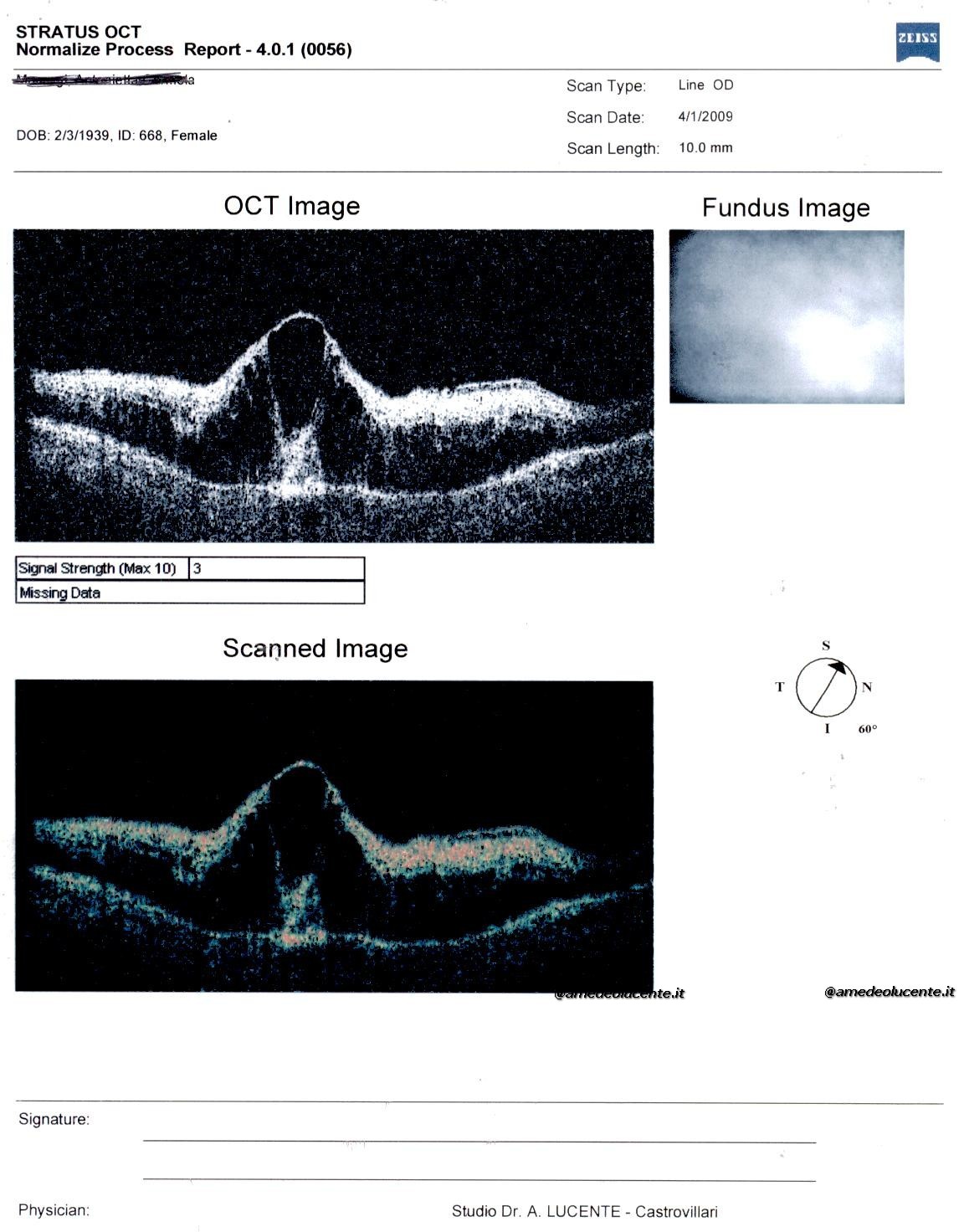 Occlusione massiva della vena centrale retina prima e dopo anti-VEGF