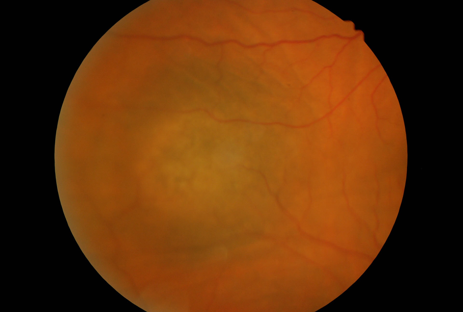 Melanoma Coroideale