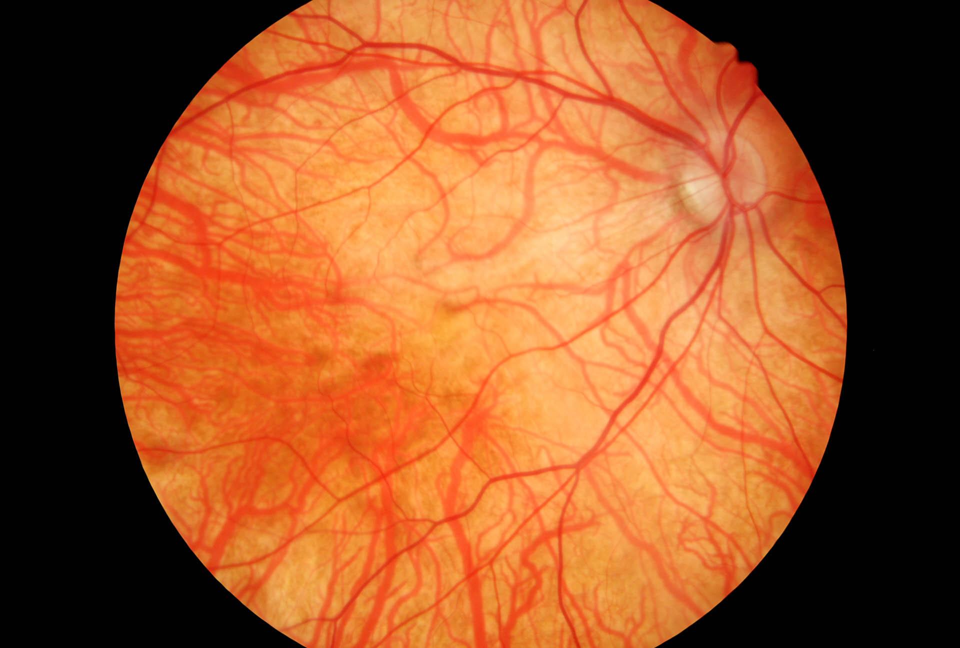 Miopia elevata con fundus albino e nistagmo