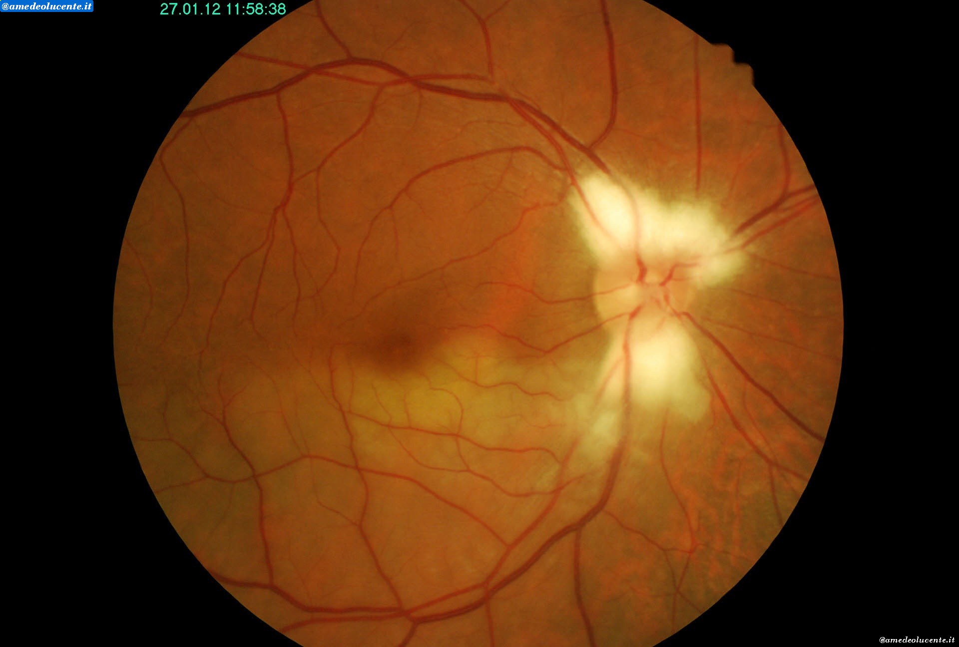 Occlusione arteria temporale retinaOcclusione emiciclica dell'arteria temporale  1 tempo