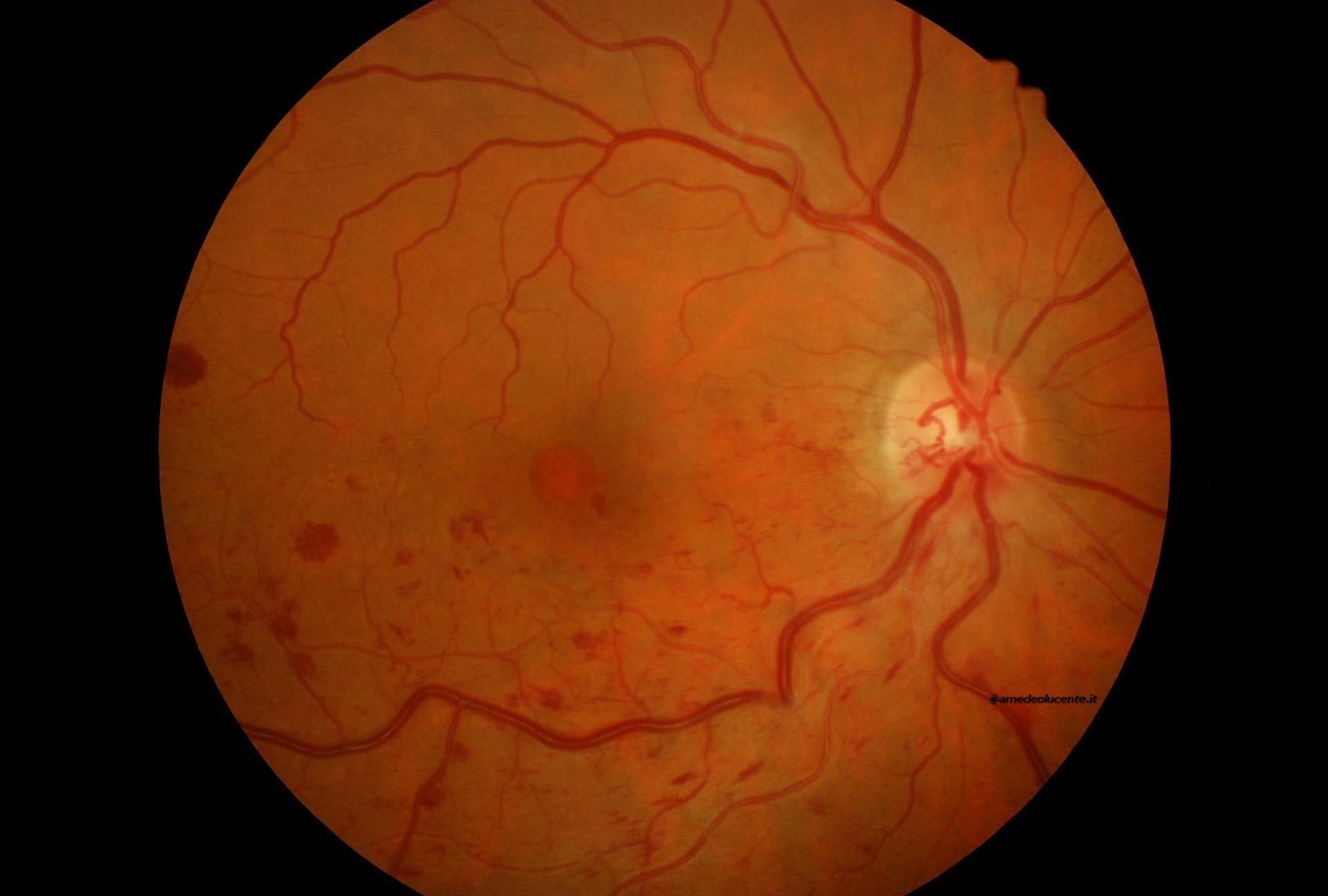 Occlusione emiciclica vena retinica inferiore comune