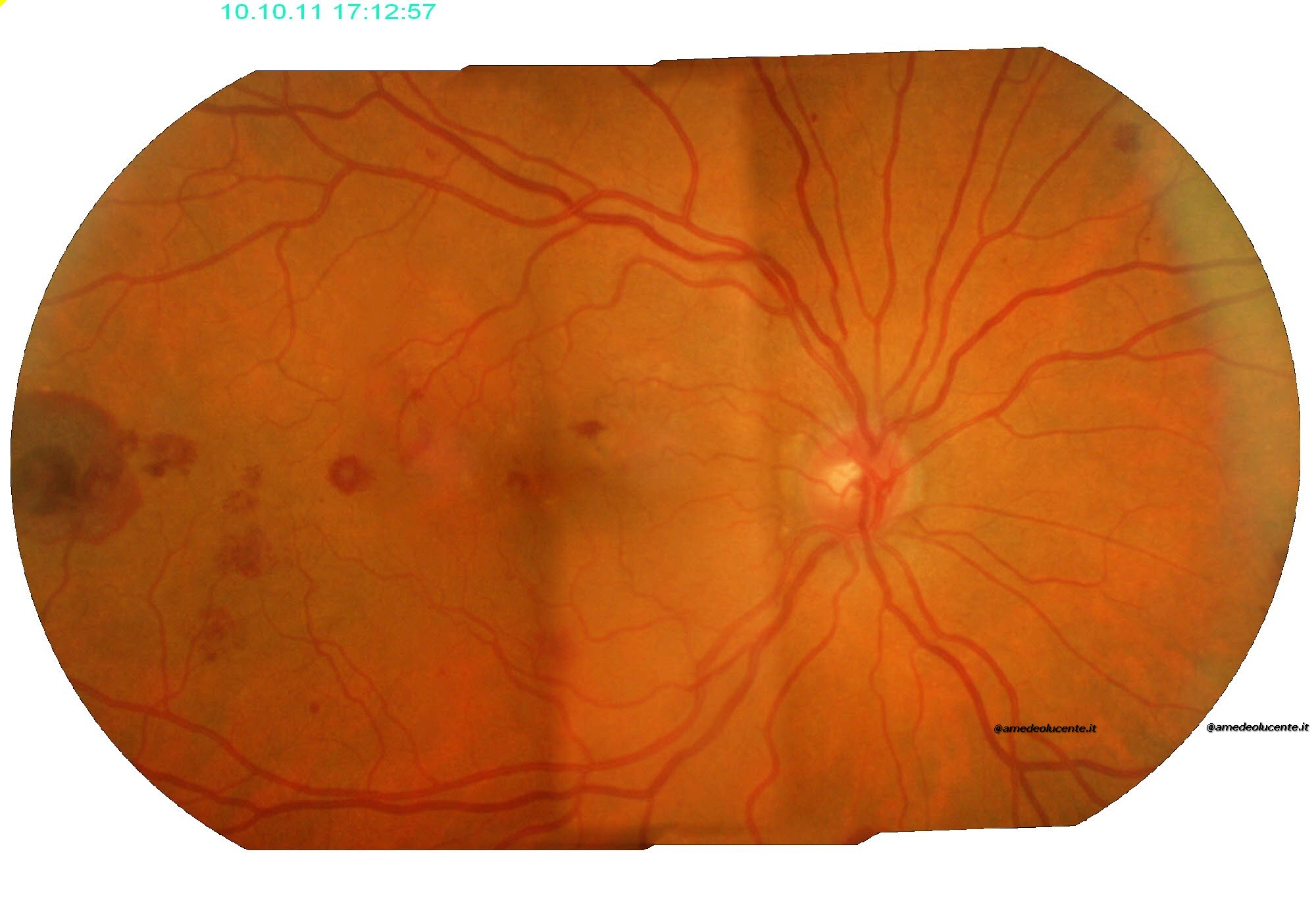 Emorragie retiniche da leucemia acuta